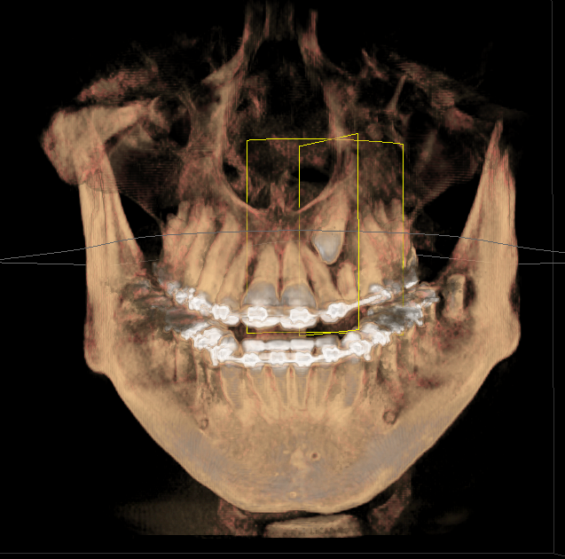 3D CT Scan