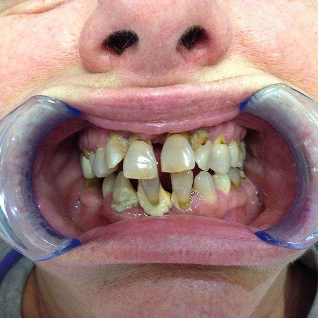 All-in-4 Dental Implant Patient Before